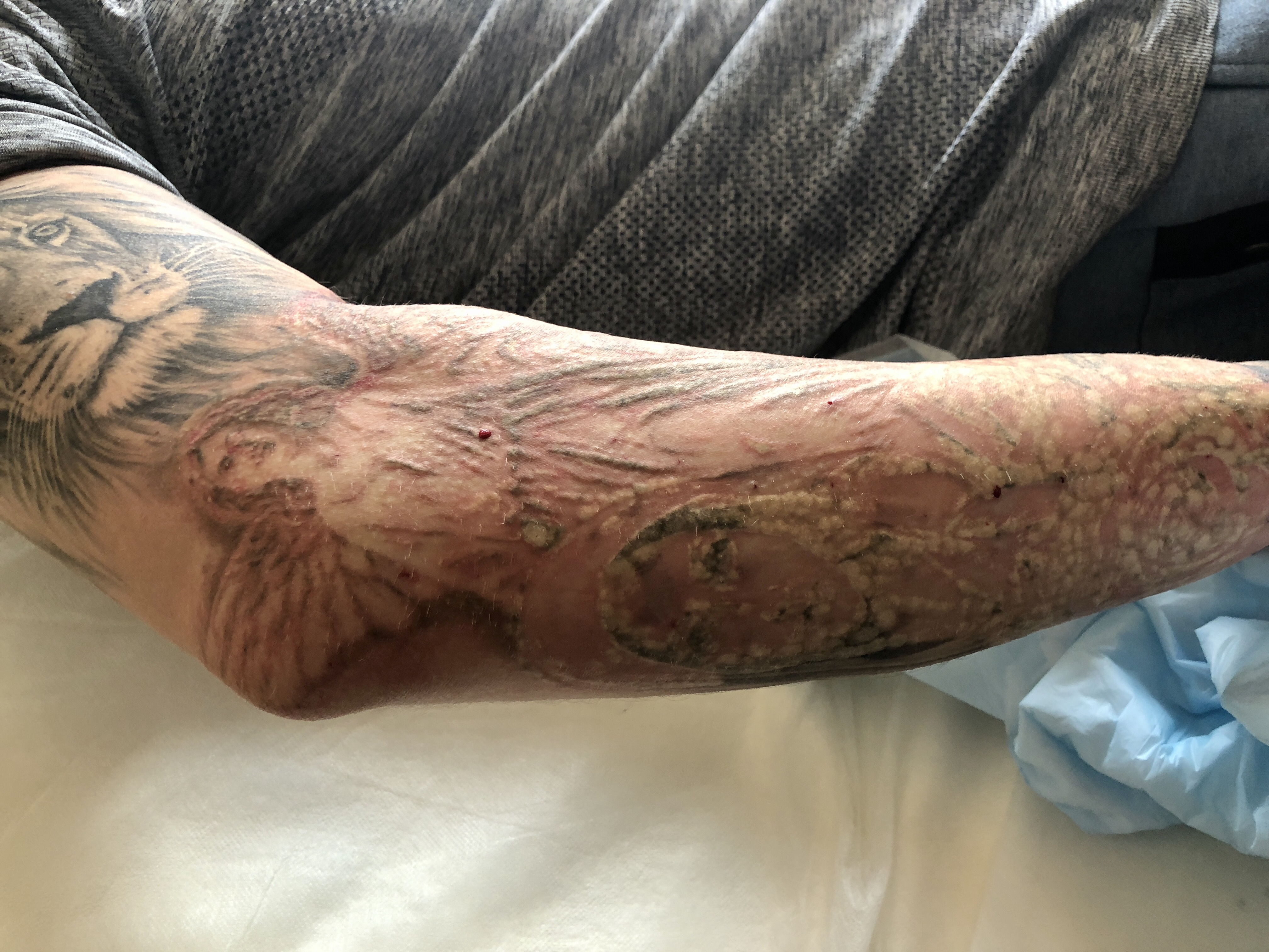 Optimizing Outcomes of Laser Tattoo Removal